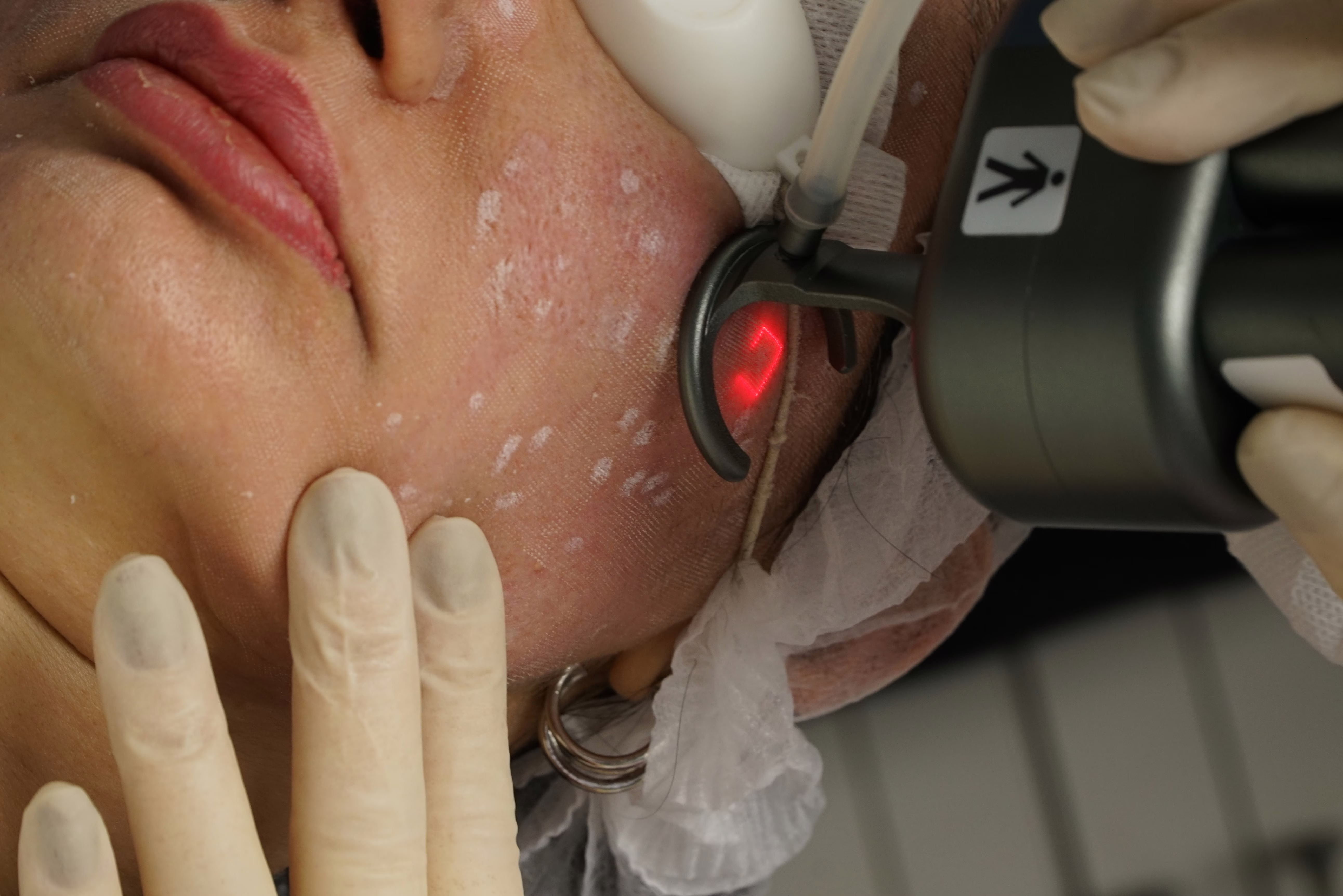 Protocolos avançados de laser