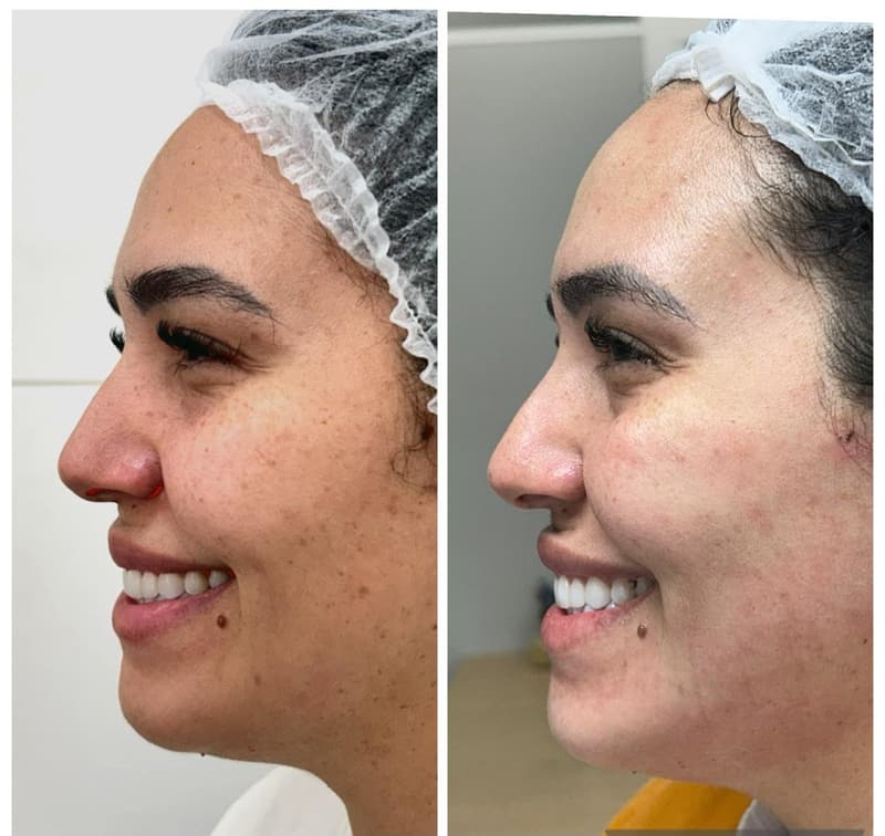 Antes e depois: textura e uniformidade da pele do rosto