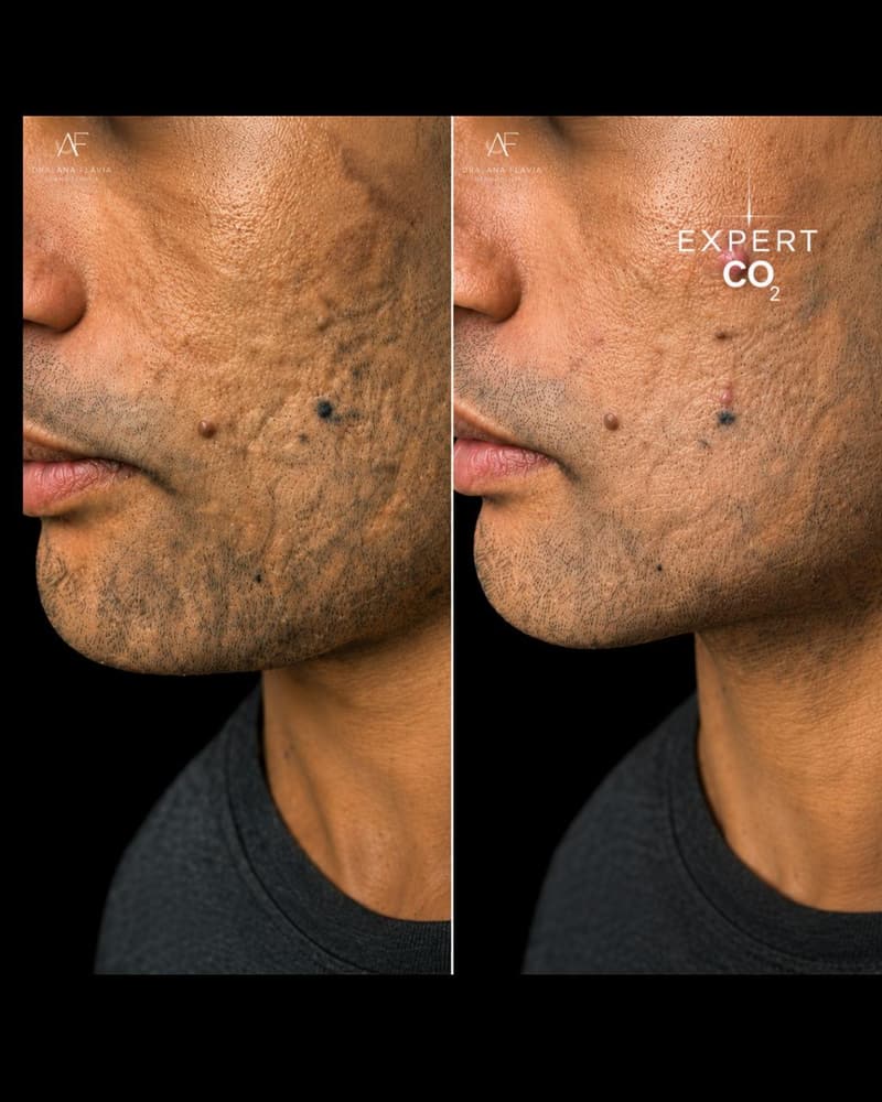 Antes e depois: cicatrizes de acne na face