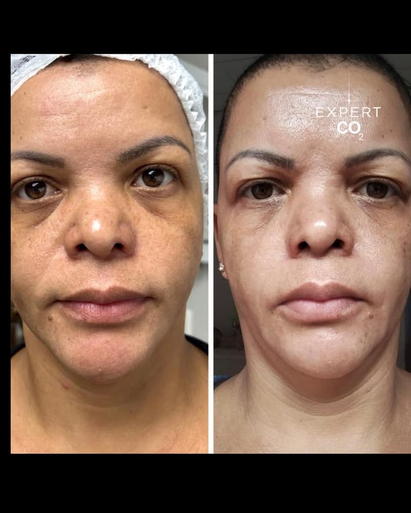 Antes e depois: firmeza e qualidade geral da pele do rosto