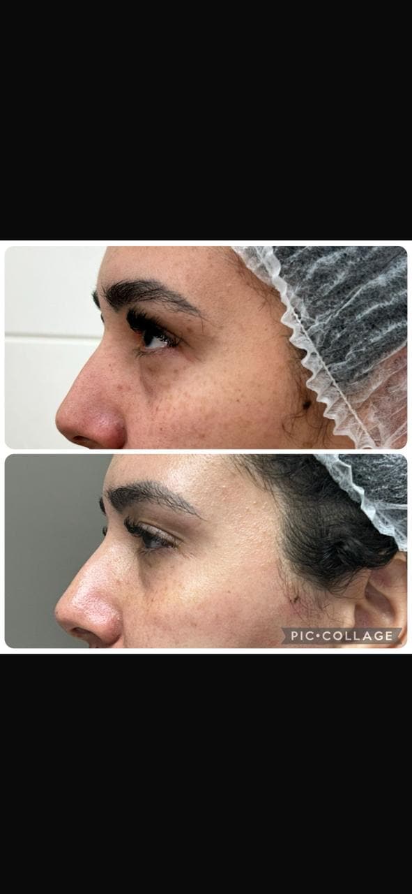 Antes e depois: região dos olhos e contorno lateral do rosto