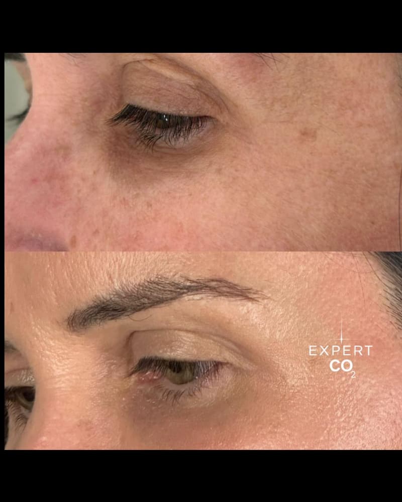 Antes e depois: rugas e linhas finas ao redor dos olhos