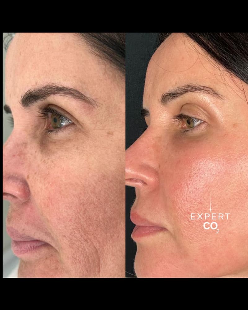 Antes e depois: rugas e flacidez da face