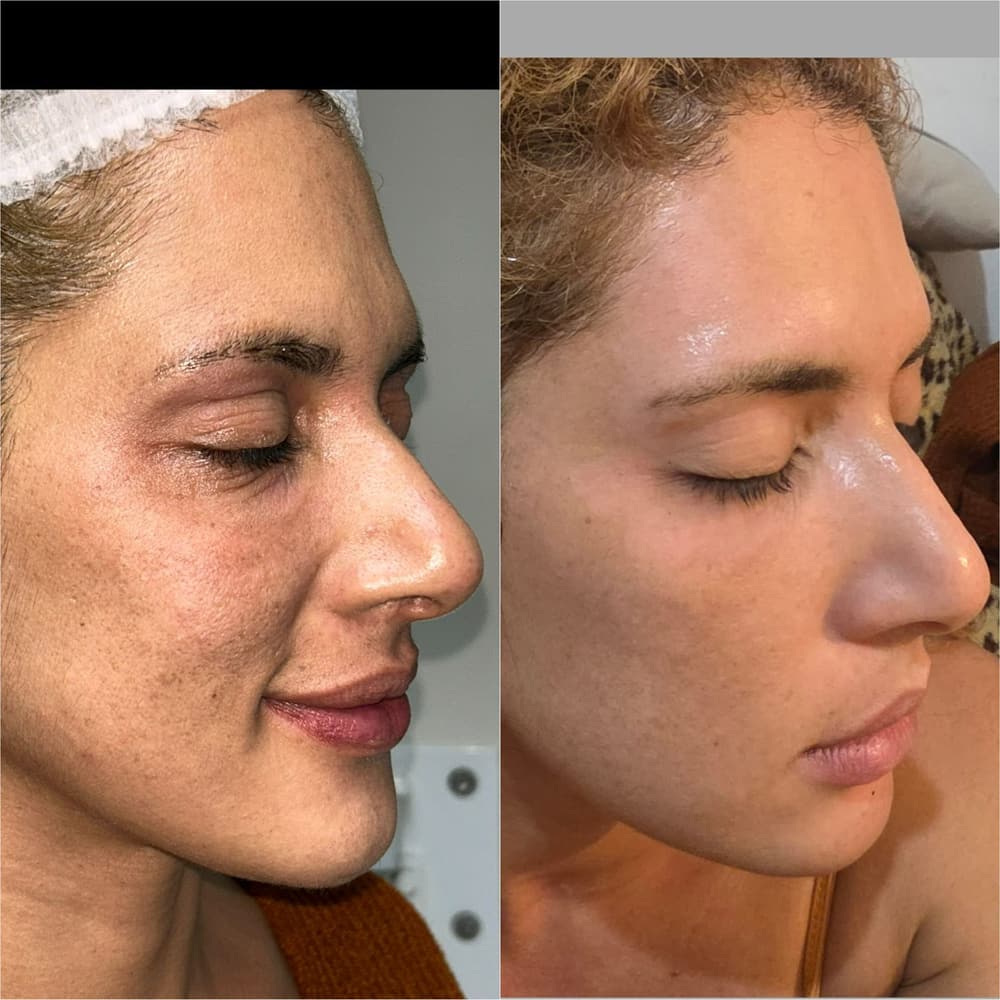Antes e depois do rejuvenescimento da região dos olhos, vista de perfil
