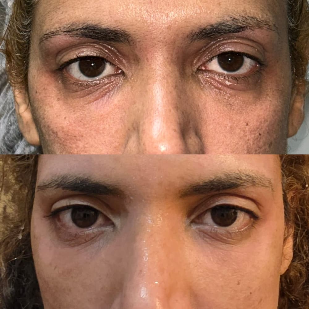 Antes e depois das pálpebras superiores e inferiores