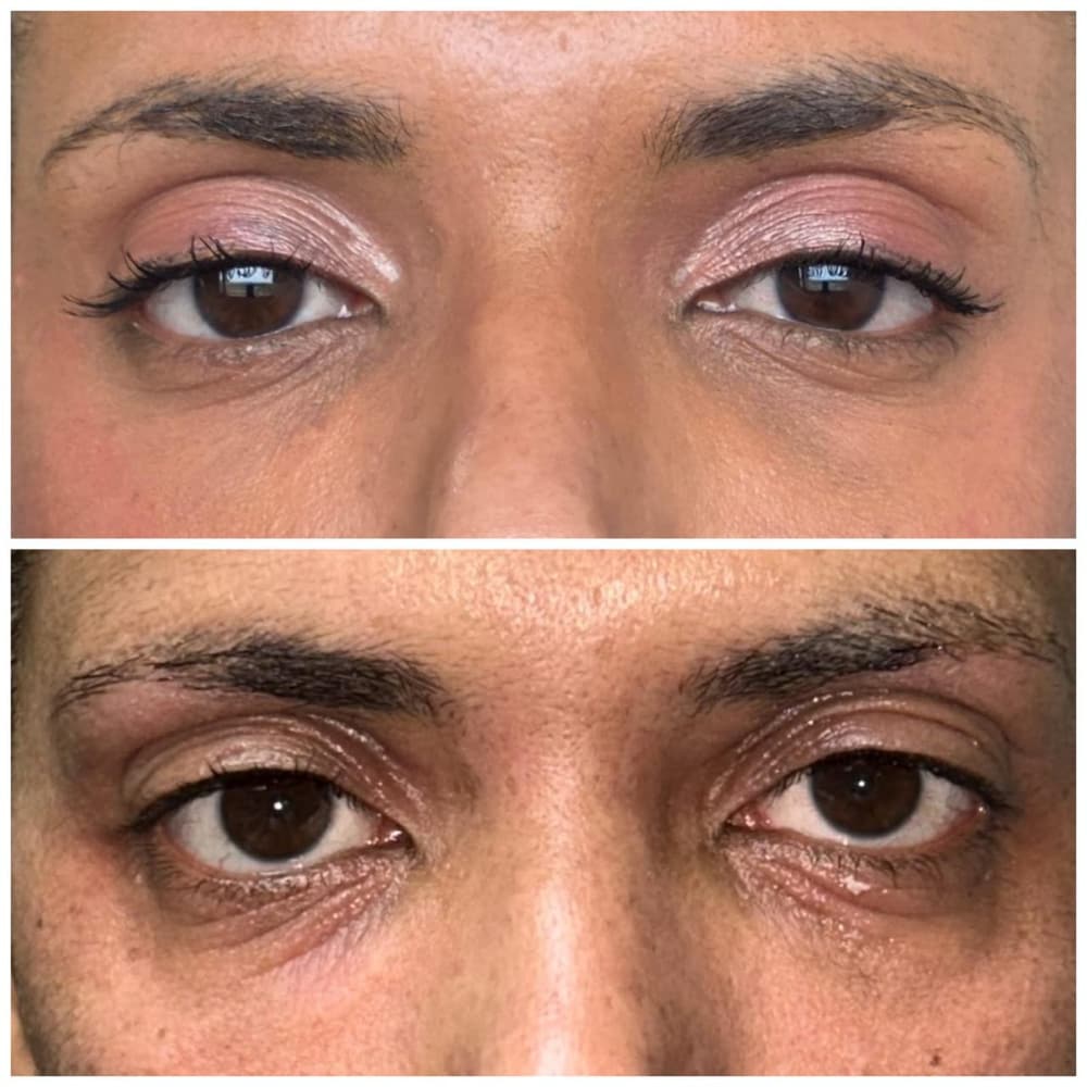 Antes e depois da flacidez e das linhas finas das pálpebras